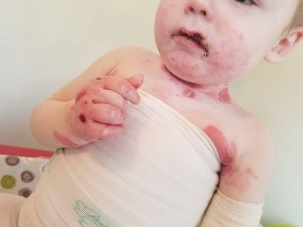 Здоровье: Малыш, кожа которого лопается от малейшего прикосновения