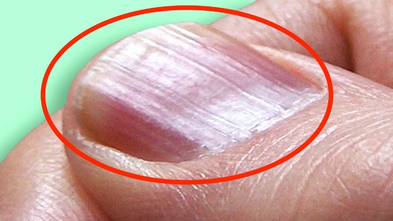 Здоровье: Проверьте свои ногти: эти отметины свидетельствуют о возможных заболеваниях