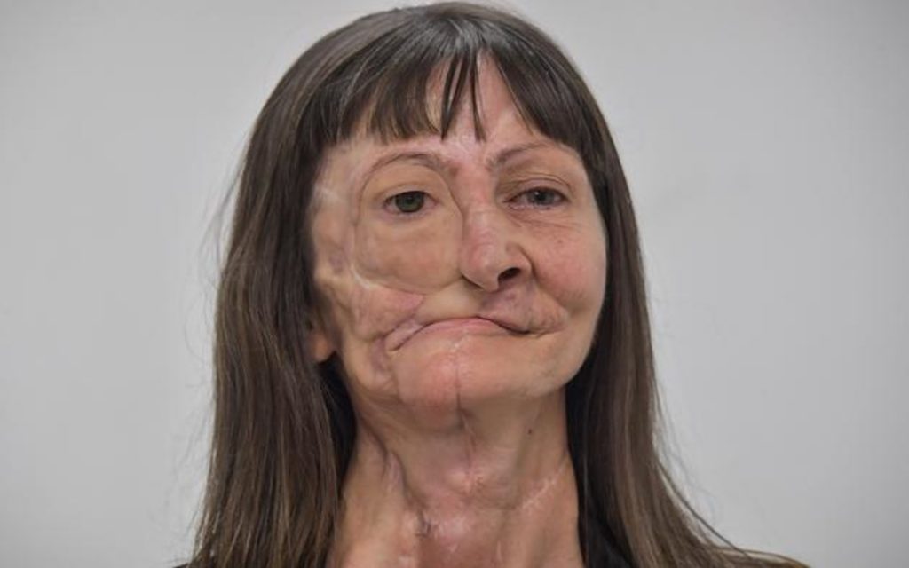 Здоровье: Онкобольная бразильянка получила новое лицо из 3D-принтера