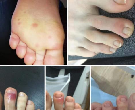 Синяки на пальцах ног: обнаружен новый симптом коронавируса